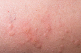 Hives: Allergic Reaction Michigan | Allergy & Asthma Center of Rochester - callout-hives